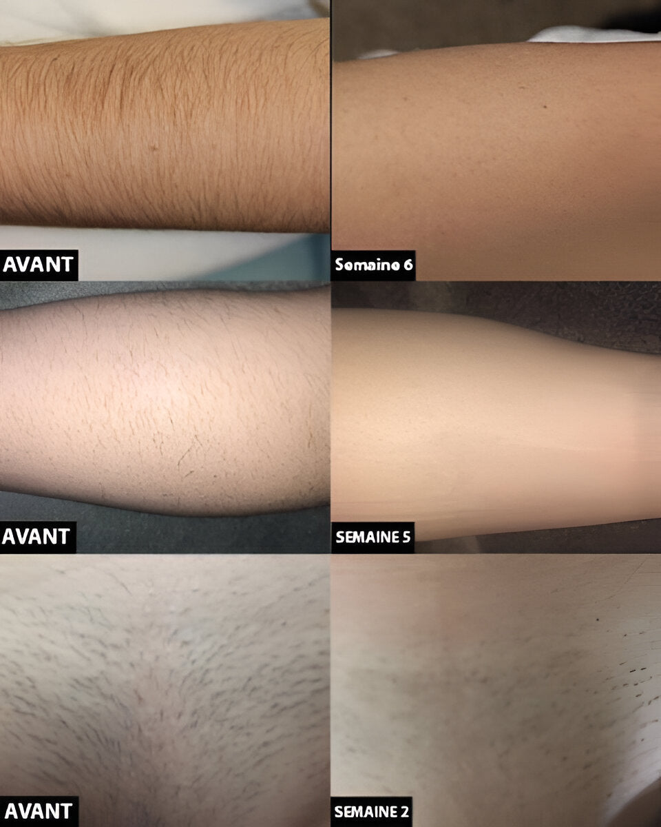 Long Lasting Laser Hair Reduction