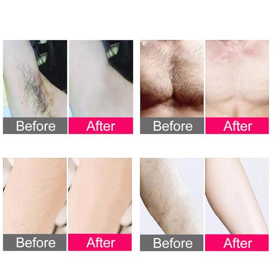 Professional At Home Hair Removal Laser Device