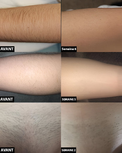Long Lasting Laser Hair Reduction